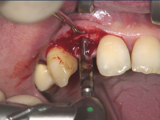 2mp implant drilling 320x240